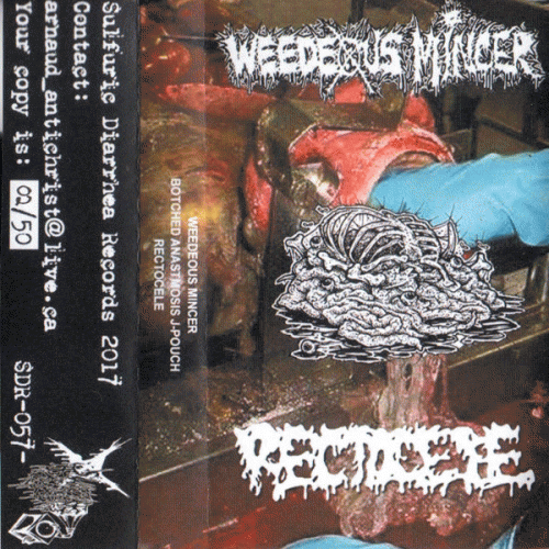 Botched Anastomosis J-Pouch : Weedeous Mincer - Botched Anastomosis J-Pouch - Rectocele